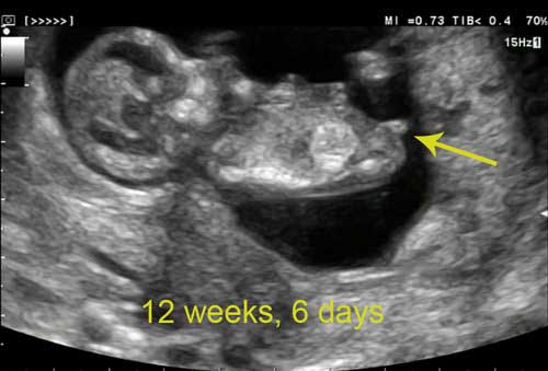 اندام تناسلی جنین پسر کی تشکیل می شود